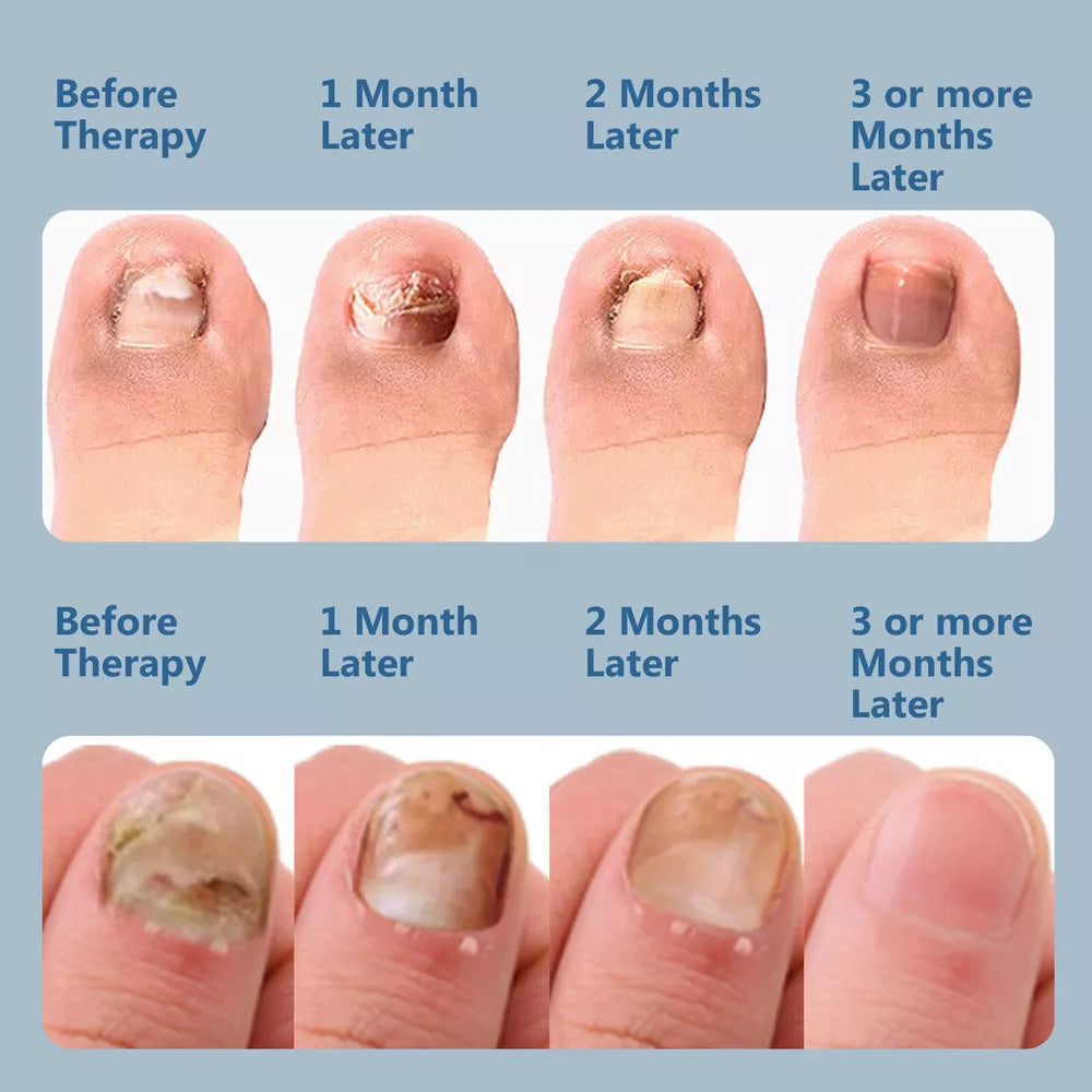 Trattamento laser NailCare contro i funghi delle unghie – terapia a doppia lunghezza d’onda